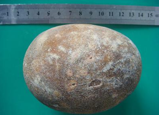 膀胱結(jié)石帶來的并發(fā)癥有哪些呢?